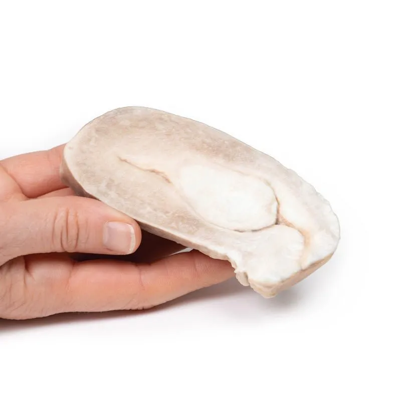 3D Printed Uterine Leiomyoma